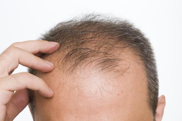 درمان ریزش مو و روش های جلوگیری از آن
