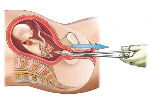 انواع روش های گوناگون سقط جنین