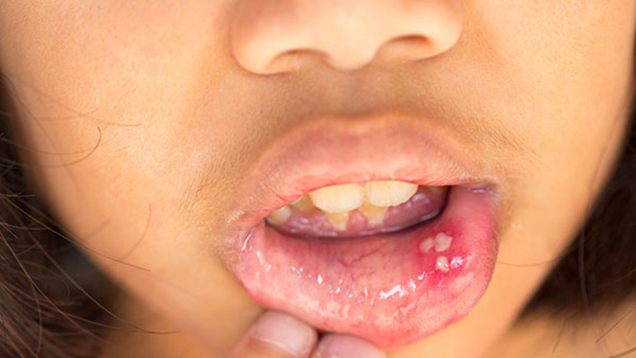 درمان آفت دهان خانگی؛ برای کودکان و بزرگسالان