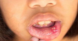 درمان آفت دهان خانگی؛ برای کودکان و بزرگسالان
